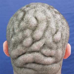 Chàng trai có hộp sọ nhăn nhúm như não