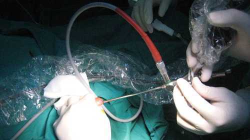 Bé 9 tuổi bị sỏi kẹt ở bàng quang