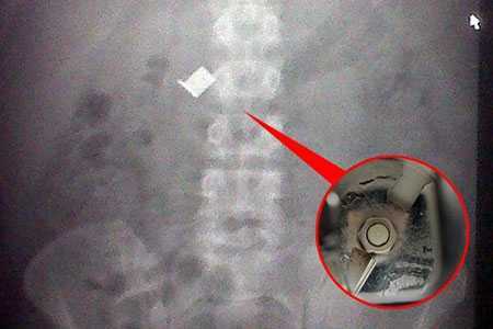 Ăn đá bào nuốt luôn... lưỡi dao