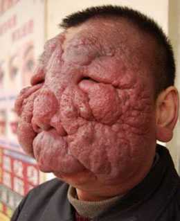 Người đàn ông bị khối u 'bò' kín mặt