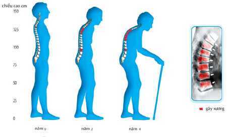 Những câu hỏi về sức khỏe của bộ xương