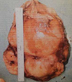 Khối u to bằng quả bưởi khiến tim suýt nổ tung