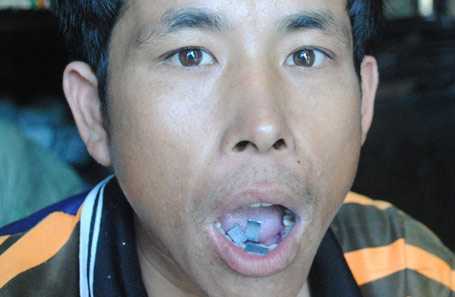 Thôn nghèo chết trẻ vì mưu sinh bằng miệng