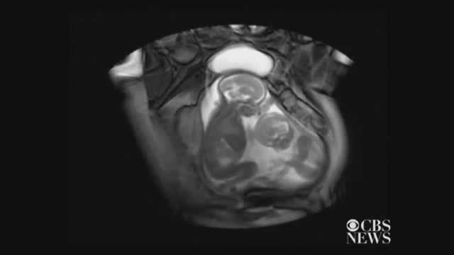 Clip: Thai song sinh 'đá nhau' trong bụng mẹ