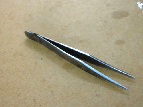 Nuốt nhíp sắt dài 12 cm, thủng ruột non