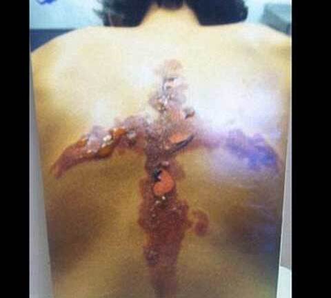 Tự làm bỏng bằng đá và muối, thú vui nguy hiểm của teen