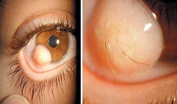 Kì quái chàng thanh niên mọc tóc trong mắt