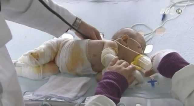 Những hình ảnh tai nạn bỏng kinh hoàng do sưởi ấm