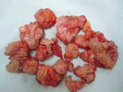 Nam sinh suýt chết vì bơm ngực, độn mông