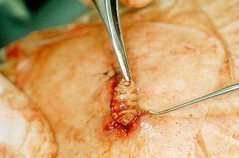 2 người bị 'giòi ăn thịt' làm tổ dưới da