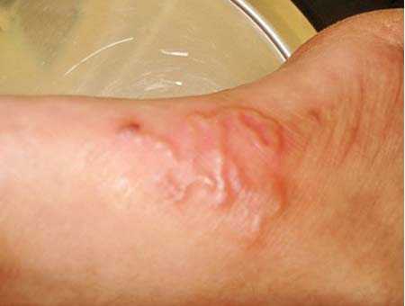 Tại sao có giun bò lúc nhúc dưới da?