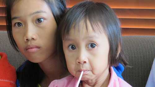 Tìm bệnh cho bé 4 tuổi có khuôn mặt như bà lão