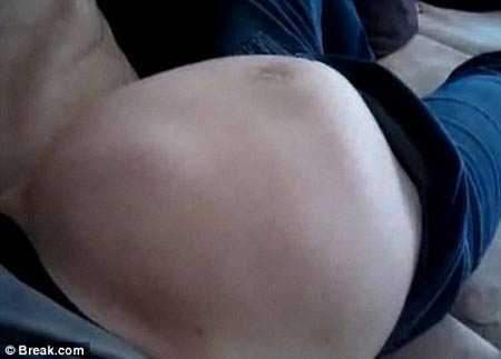 Clip: Bào thai đạp bụng mẹ biến dạng