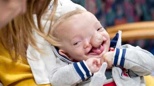 Cứu sống bé trai mặt bị chẻ làm hai