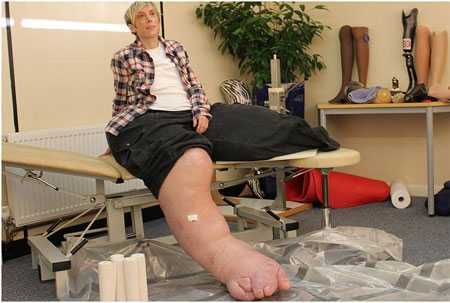 Người phụ nữ có chân phải nặng 108 kg