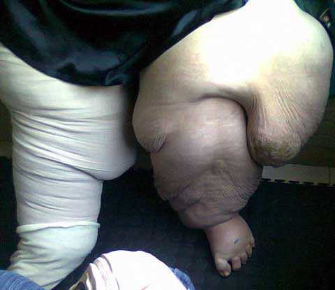 Một lần muỗi đốt, 5 năm liệt giường