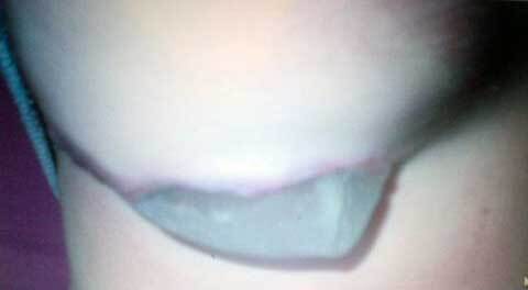 Sốc khi thấy ngực giả lòi ra ngoài cơ thể