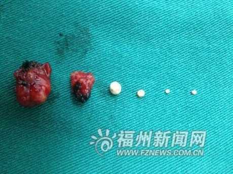 Kỳ lạ mắt cô gái tự sản xuất ra trân châu