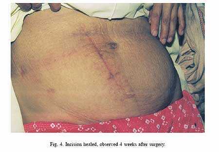 Những ca tự mổ kinh điển nhất thế giới