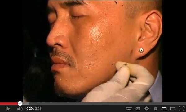 Giòi lúc nhúc bò ra từ mặt