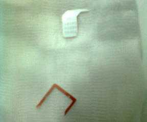 Giật mình SIM điện thoại mắc trong thực quản trẻ