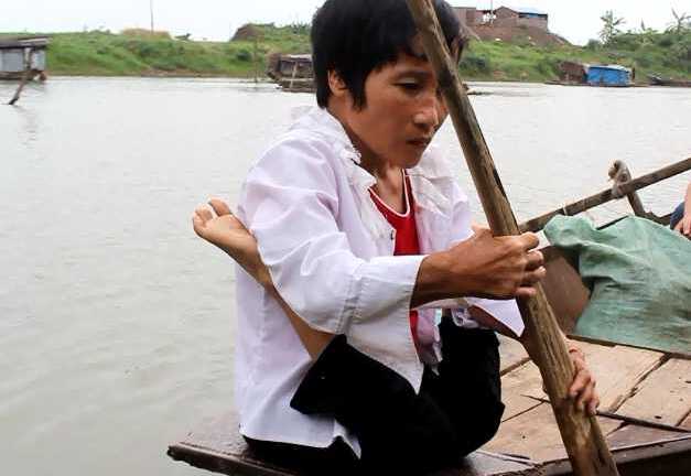 Xót xa người phụ nữ có đôi chân hình chữ V