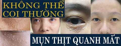 Không thể coi thường mụn thịt quanh mắt