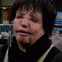 Rùng mình khuôn mặt biến dạng vì dầu ăn