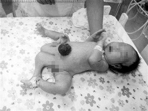Thương cậu bé 4 chân, 2 bộ phận sinh dục bị bỏ rơi
