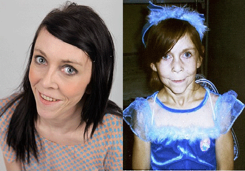 Thiếu nữ 16 như bà già 60 tuổi được cứu thế nào?