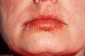 Bôi nhầm keo siêu dính, miệng không thể mở