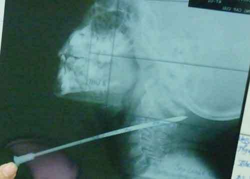 Xót xa bé 5 tuổi bị nan hoa xe máy đâm xuyên cổ