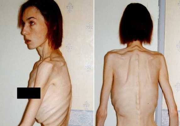 Trở thành 'bộ xương di động' chỉ vì một lời nói