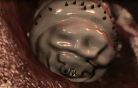 Giòi ăn thịt người bò lúc nhúc trong bụng