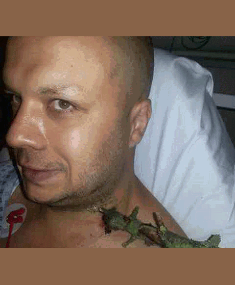 Cảnh cây 40cm đâm vào cổ: Thoát chết kỳ diệu