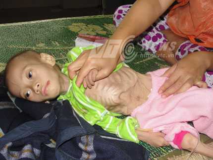 Điều dưỡng khóc ròng lau thi thể bệnh nhi xấu số