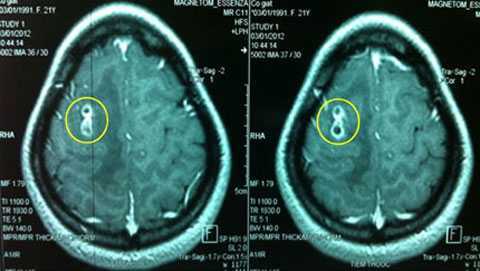 Người đàn bà bị giun chui vào não