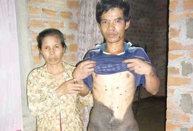 Chàng trai với 'lớp da trâu' trùm nửa cơ thể