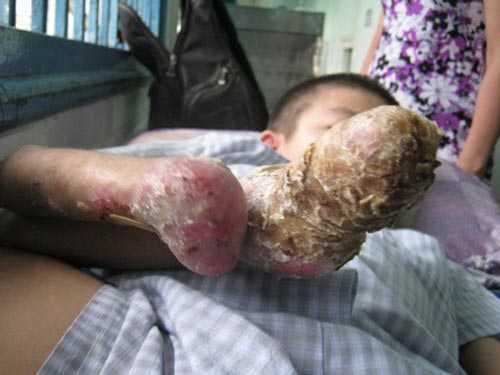 Hé lộ nguyên nhân bệnh tứ chi thối rữa, rụng dần