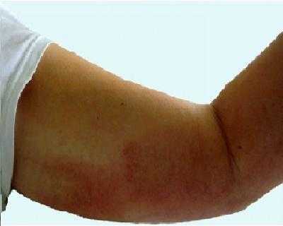 Chơi với mèo, tay chân nhiễm vi rút hiếm