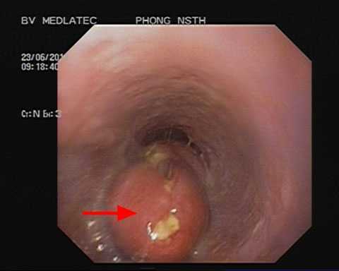 Được giáo sư hội chẩn mới phát hiện ung thư