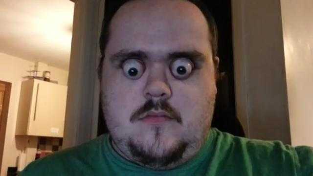 Người đàn ông có đôi mắt 'muốn rơi ra ngoài'