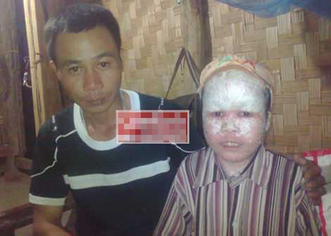 Cậu bé ‘người cá’ suýt bị chôn sống ở Hà Giang