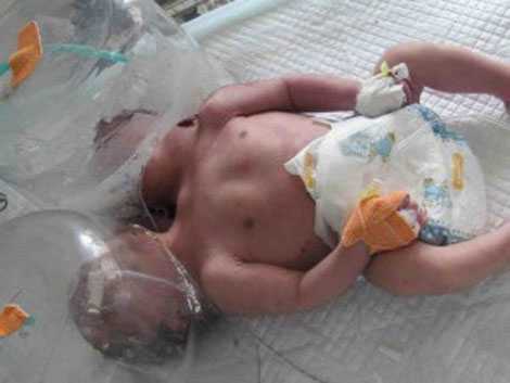 Bé hai đầu mới chào đời