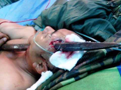 Người bị xà beng đâm xuyên đầu