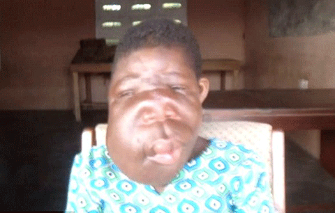 Xót xa bé gái mồ côi có khuôn mặt quỷ