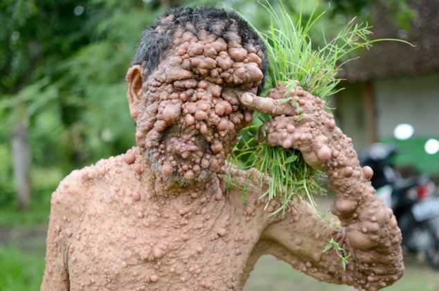 Dựng tóc gáy với người đàn ông mọc mụn như sung