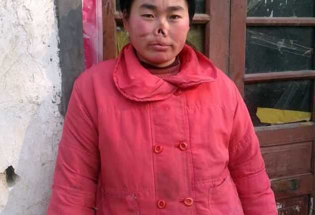 Rùng mình cô gái bị chuột cắn mất mũi, môi