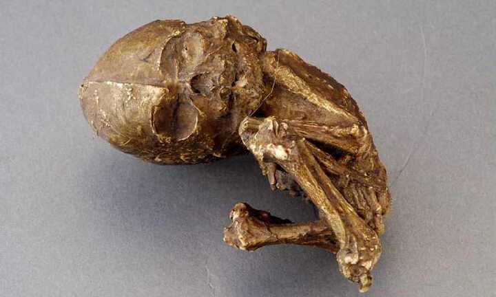 Kỳ dị bào thai hóa đá 40 tuổi trong bụng mẹ 82 tuổi