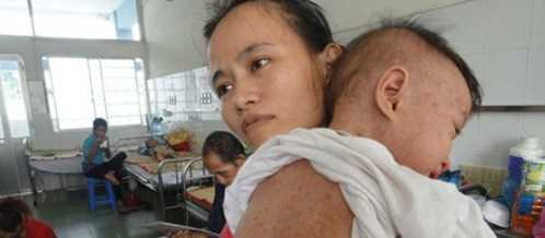 Không tiêm phòng sởi, bé gái nguy hiểm tính mạng